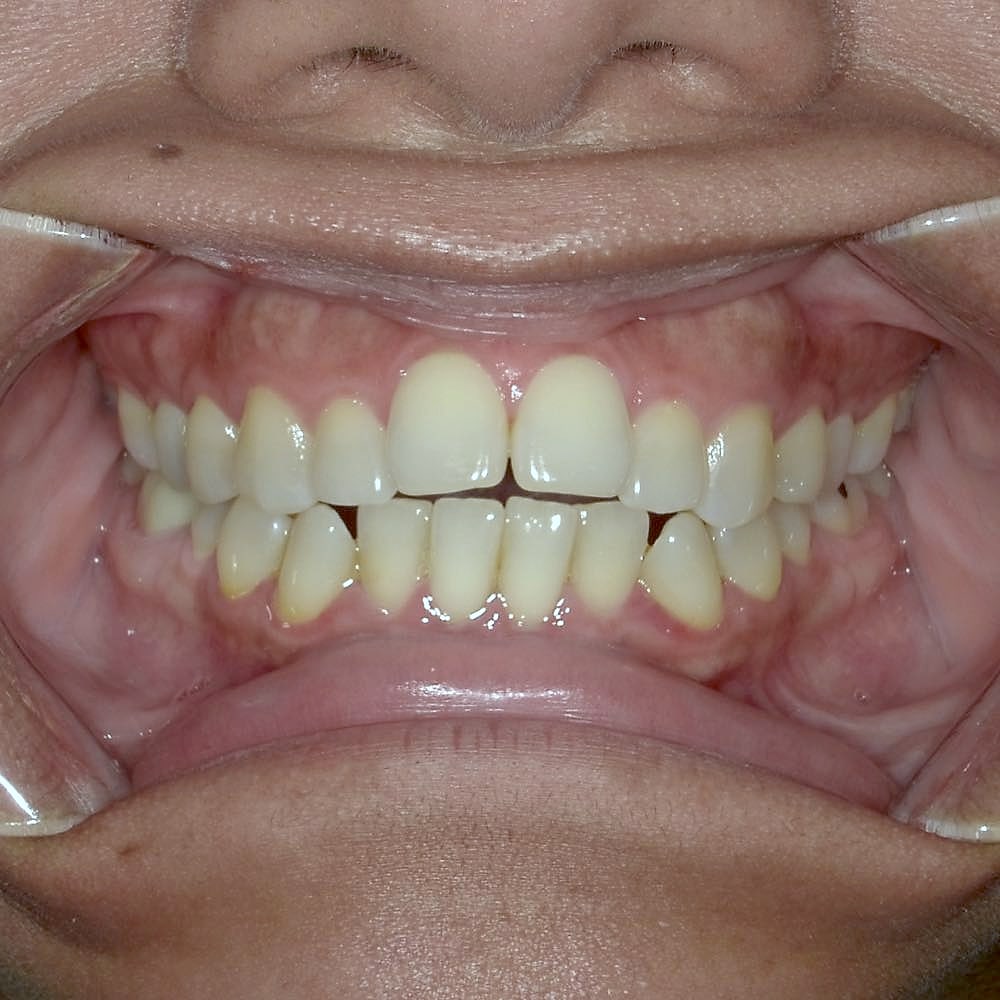 Juanita's teeth before orthodontic treatment at Harmony Orthodontics