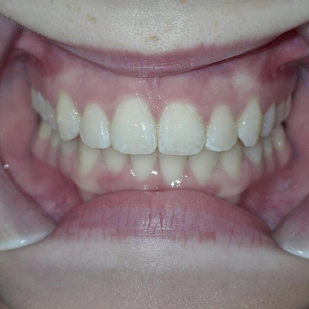 Kayden's straight, aligned teeth after orthodontic treatment at Harmony Orthodontics