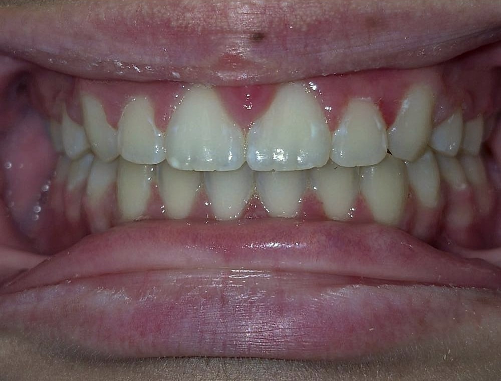 Mila's straight, aligned teeth after orthodontic treatment at Harmony Orthodontics
