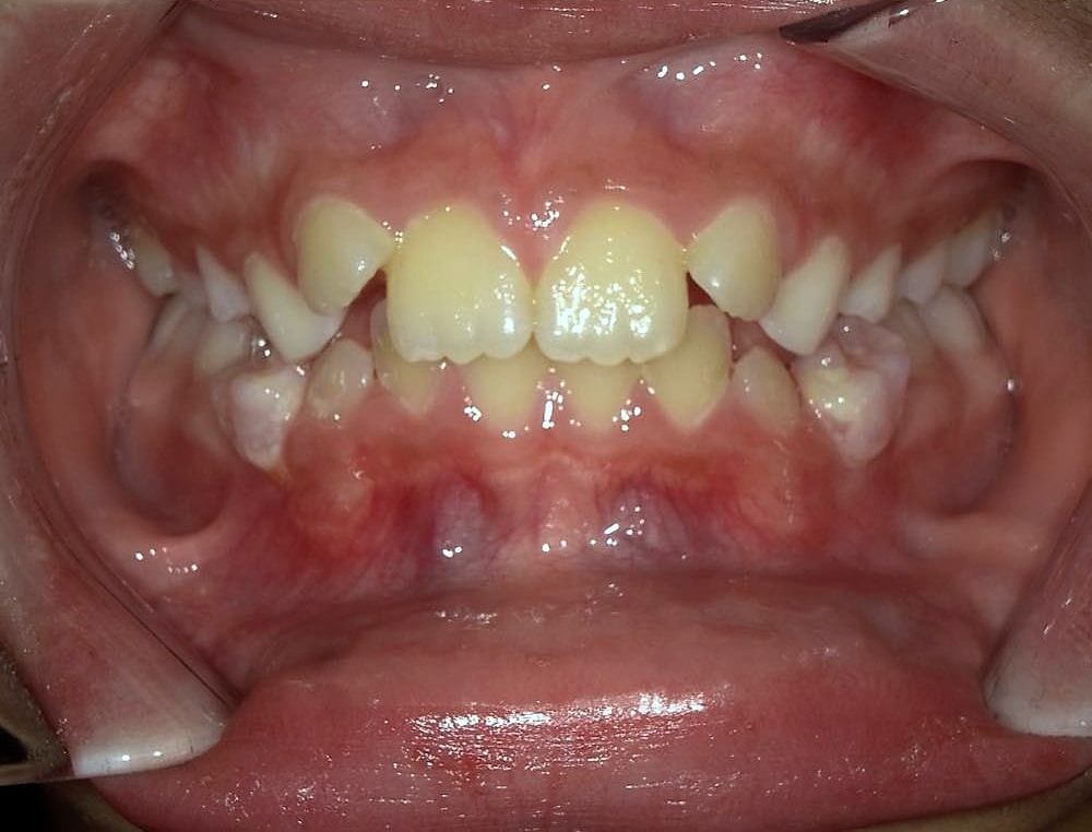 Mila's teeth before orthodontic treatment at Harmony Orthodontics