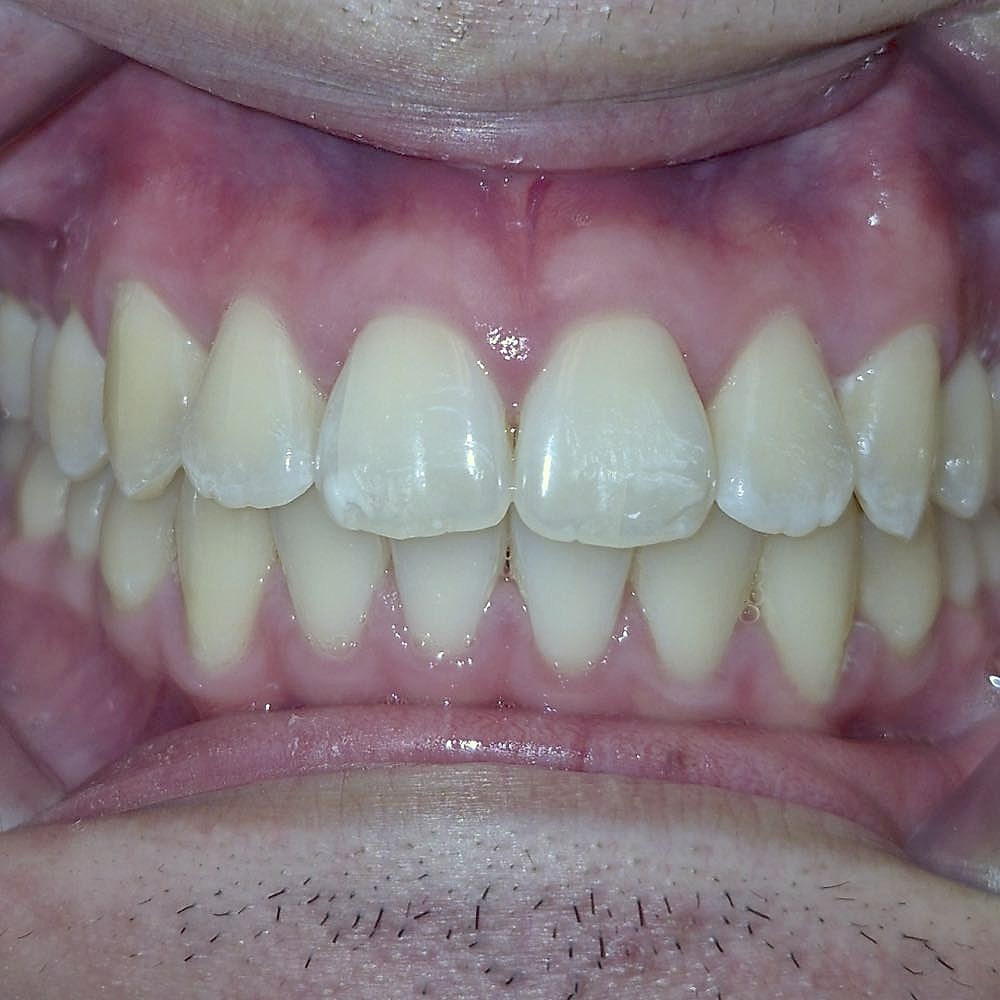 Vincent's straight, aligned teeth after orthodontic treatment at Harmony Orthodontics