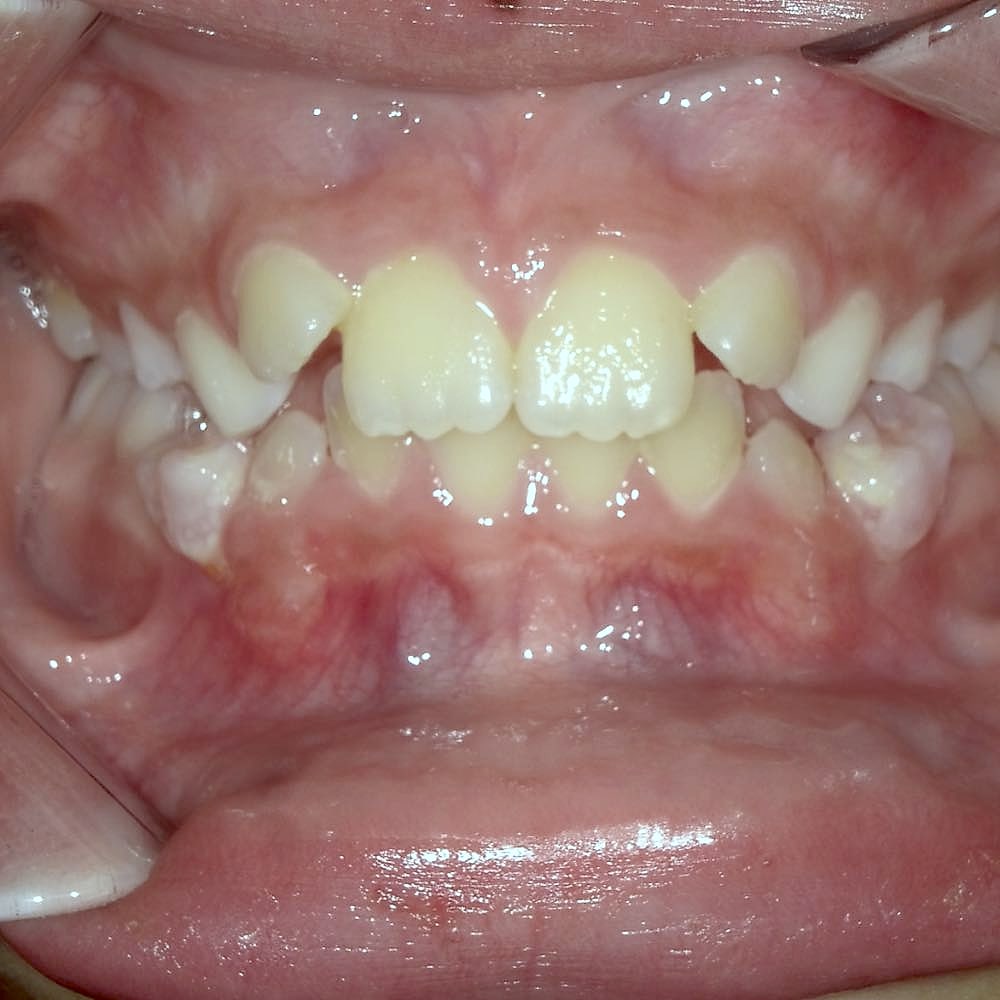 Vincent's teeth before orthodontic treatment at Harmony Orthodontics